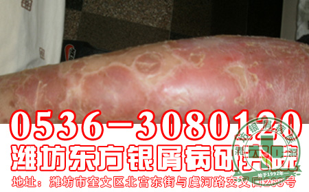 银屑病患者日常有哪些禁忌