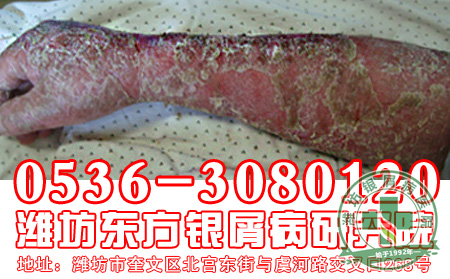 银屑病治疗应该做到哪些?