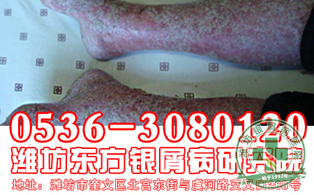 银屑病治疗时应该做好什么护理工作?