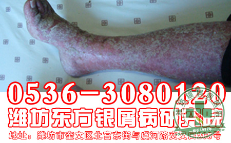 患者怎样做能够减少银屑病发病危害