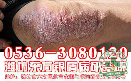 银屑病心理护理应该怎么样做?