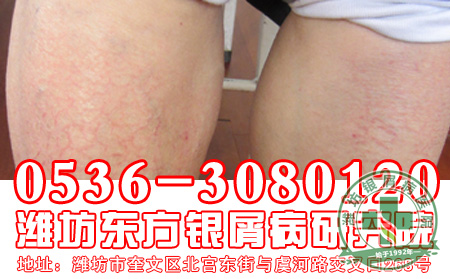 银屑病的药物使用要注意什么