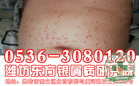 银屑病发病危害包括哪一些