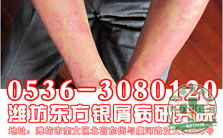 银屑病应该怎样做好营养补充?
