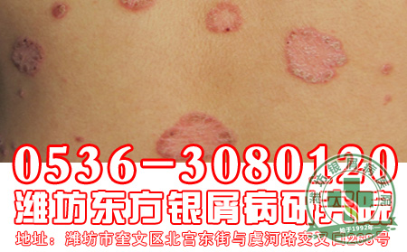 银屑病患者应该了解的常识有哪些