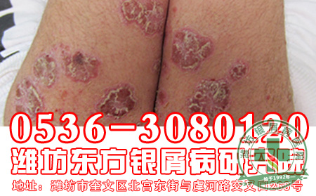 银屑病患者怎样饮食比较好？
