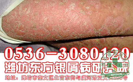 银屑病患者饮食要注意什么问题?