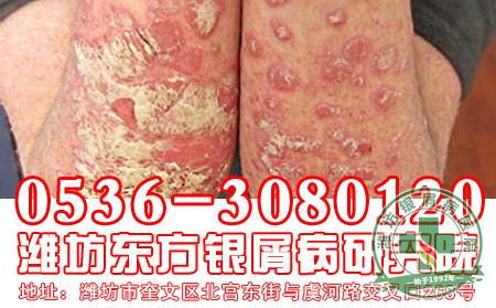 银屑病用药要注意哪些禁忌？