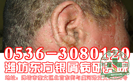银屑病具有传染性吗