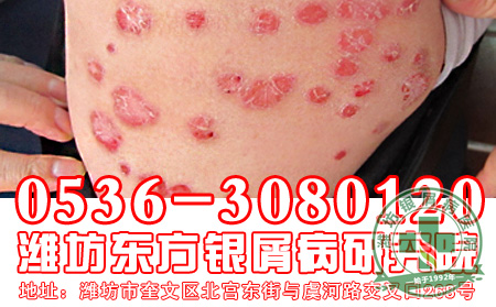 银屑病饮食要做到哪些禁忌?
