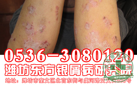 银屑病病情恶化的原因包括什么