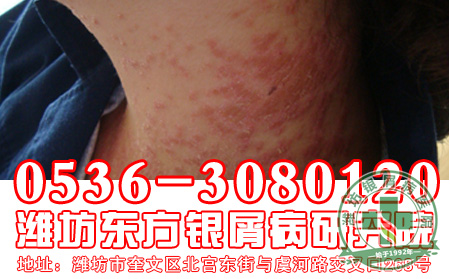 银屑病治不好的原因是什么
