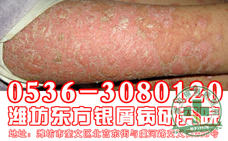银屑病患者在日常生活中应该注意哪些禁忌问题