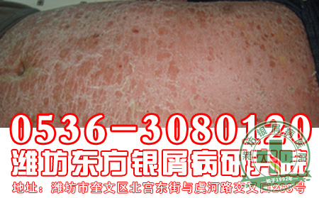 银屑病的防护工作应该做好哪些