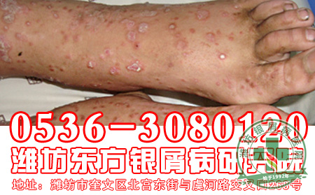 心理因素对于银屑病有什么影响?