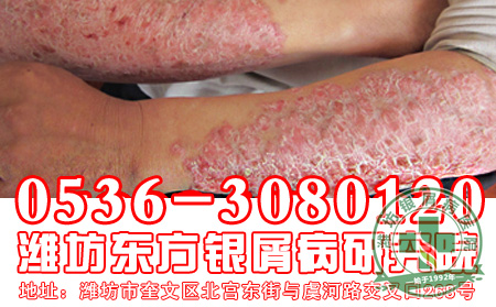 为什么济南银屑病专科医院的主任说银屑病不传