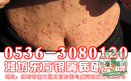 银屑病患者要注意哪些日常禁忌？