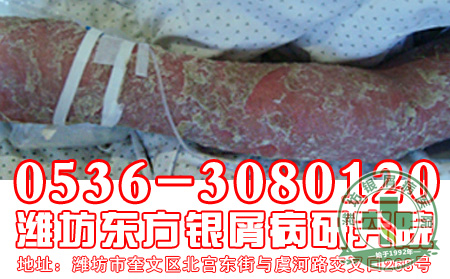 红皮型银屑病的发病症状是什么样的？