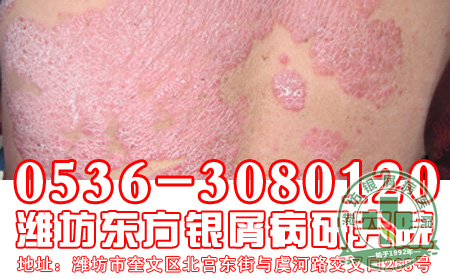 银屑病患者为什么可以食用蜂王浆？