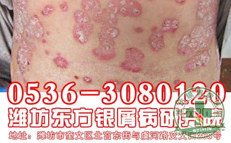 银屑病患者吃香瓜要注意什么?