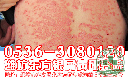 银屑病饮食要做好什么禁忌？