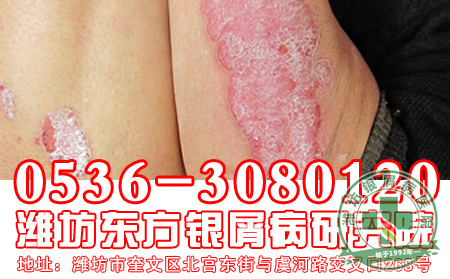 银屑病发病后患者怎样做好防护工作好?