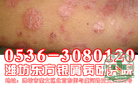银屑病的治疗应该注意到哪一些?