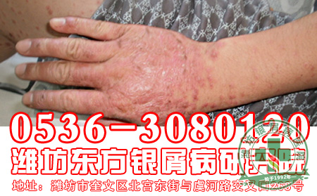 银屑病发病后患者应该注意什么行为禁忌？