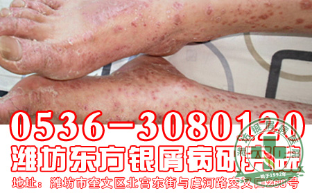 银屑病如果不注意及时治疗会造成什么危害?