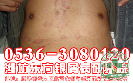 患了银屑病后患者为什么要到正规医院进行治疗