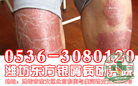 患者应该怎样对待红皮型银屑病？