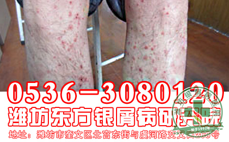 银屑病怎样减少病情出现复发?