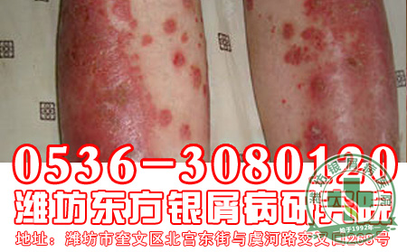 银屑病要注意怎样用药?