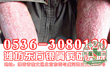 寻常型银屑病的饮食工作要怎么做？