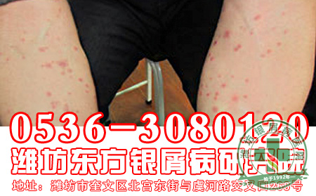 寻常型银屑病的症状和危害是怎样的？