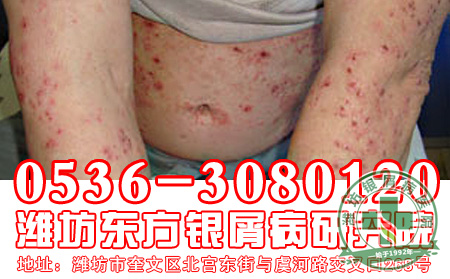 患上寻常型银屑病会出现什么危害呢?