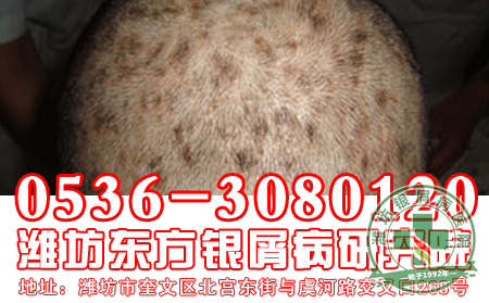 患者对于头部银屑病应该注意什么?