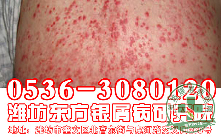 济南银屑病医院主任提醒大家应该怎样减少银屑