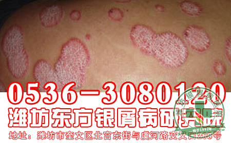 寻常型银屑病为什么也要治疗?