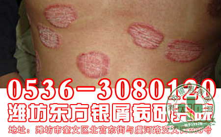 怎样治疗银屑病 好？听听济南银屑病医院主任