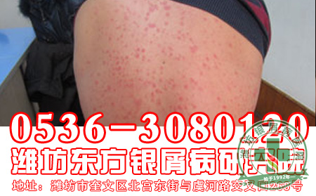 寻常型银屑病治疗你知道要做哪些吗?
