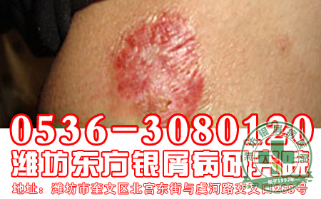 换季怎么样避免银屑病复发?