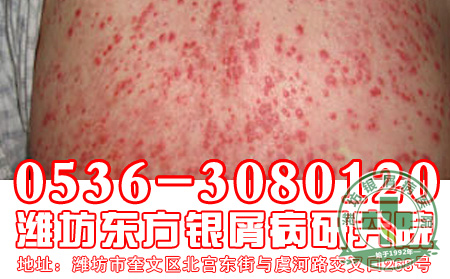银屑病用药要注意做好哪些问题?
