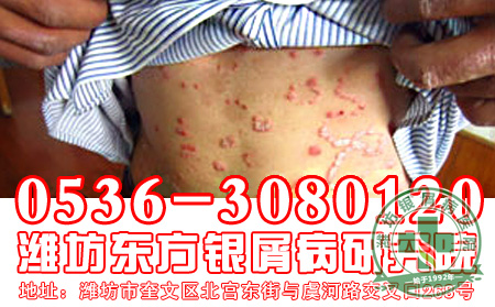 银屑病用药治疗有什么患者应该遵循的原则?