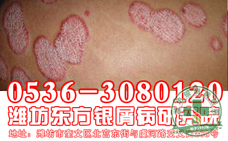 银屑病治疗要注意做好哪些禁忌问题？