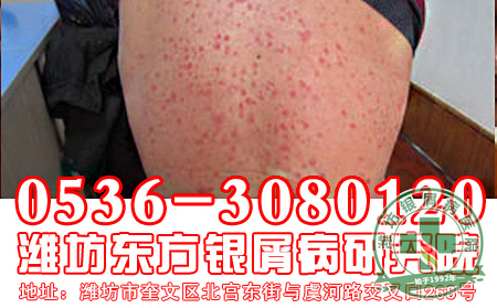 银屑病真的能治好吗？