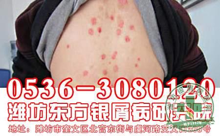针对银屑病复发，患者要怎样做好防护工作？