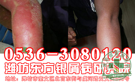 减少遗传，银屑病患者应该怎样选择受孕？