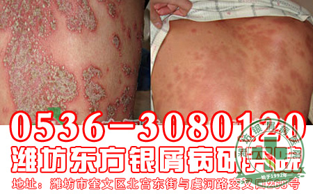 寻常型银屑病治疗要做好哪些工作？