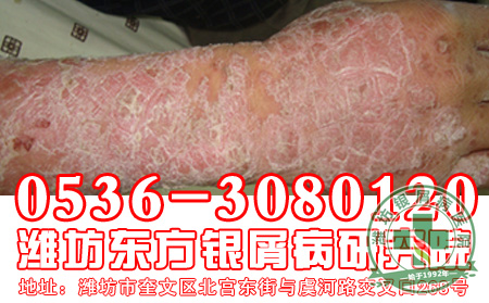 银屑病患者对于银屑病的偏方应该抱着怎样的态